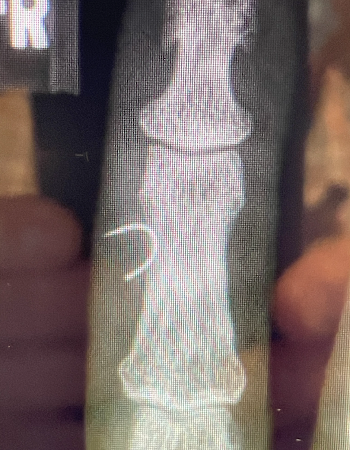 Xray of a fish hook in a man's finger.